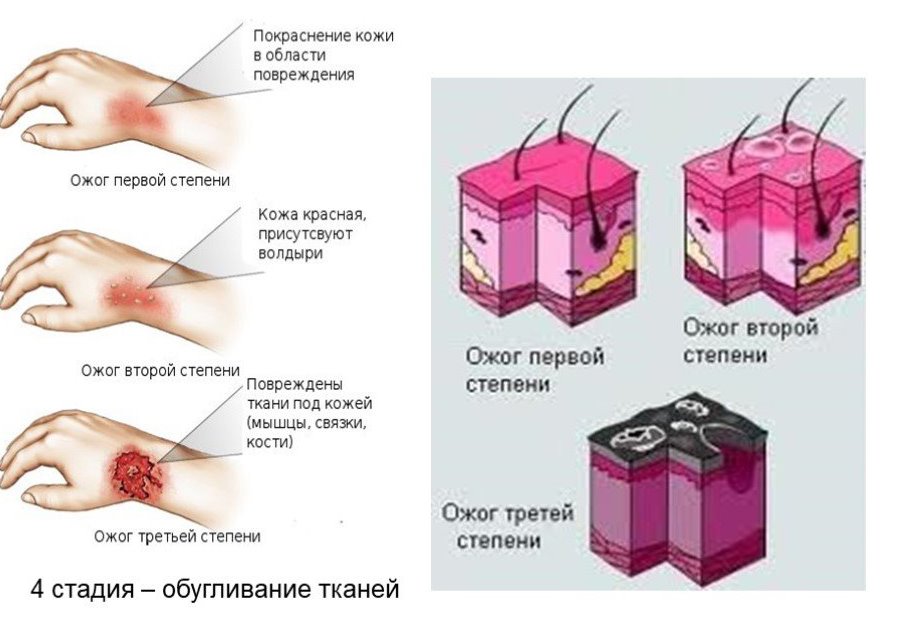 Химический ожог рисунок